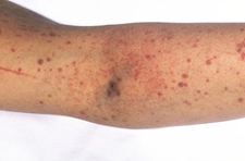 Bebeklerde Trombosit Düşüklüğü Belirtileri ve Tedavisi